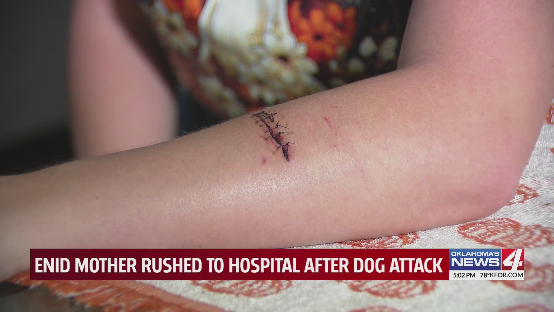Enid mother rushed to hospital after dog attack – KFOR.com Oklahoma City