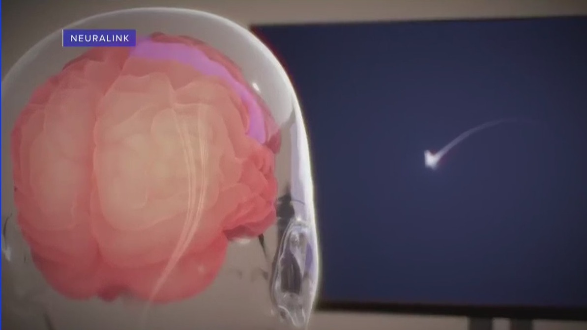 FDA approves Neuralink chip for second patient | NewsNation Now ...