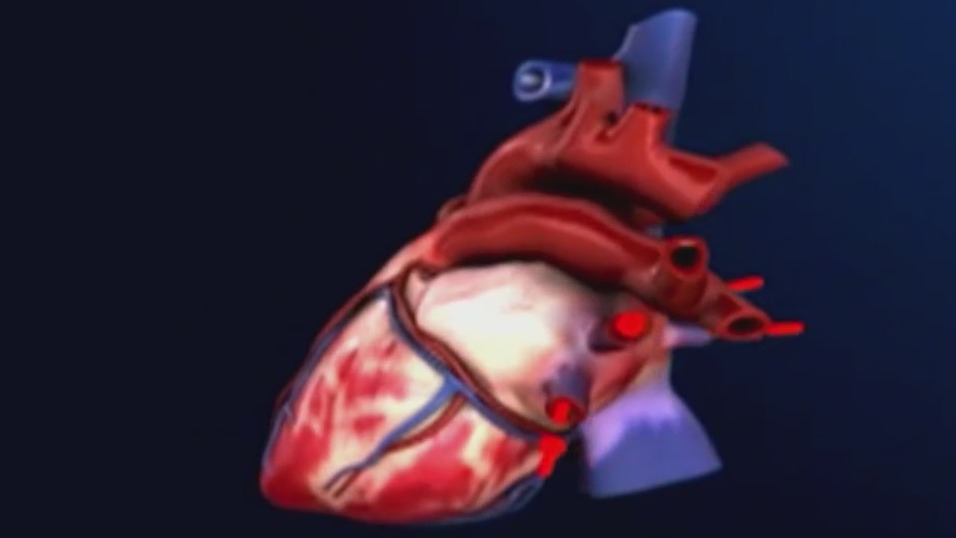 COVID infection linked to higher risk of heart complications: Study ...