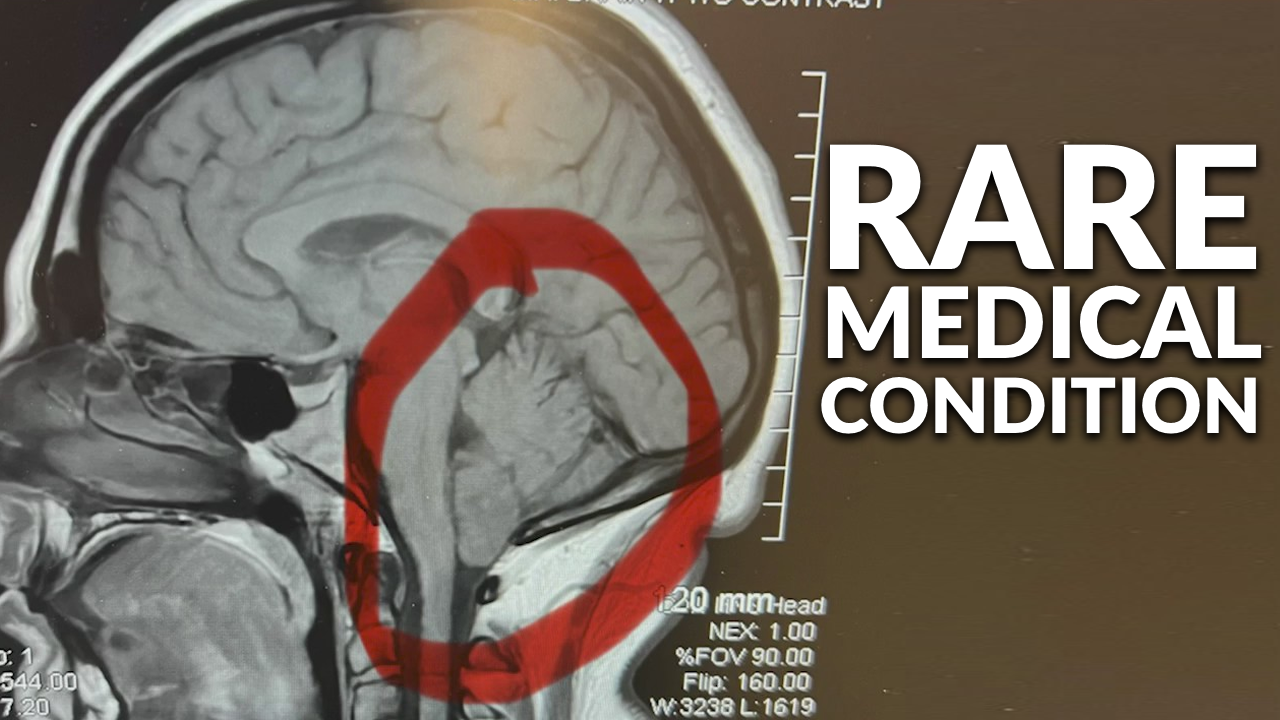 Medical Anomaly Rip Local woman raising awareness ahead of surgery for rare medical ...