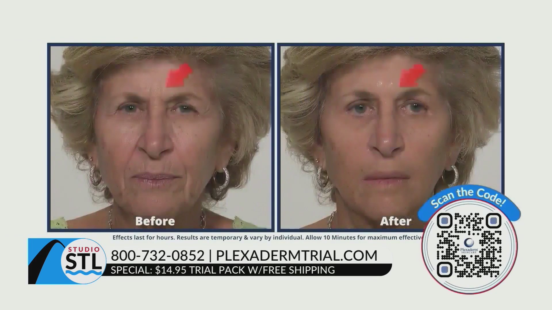 Treat yourself and get younger-looking skin with Plexaderm! – FOX 2