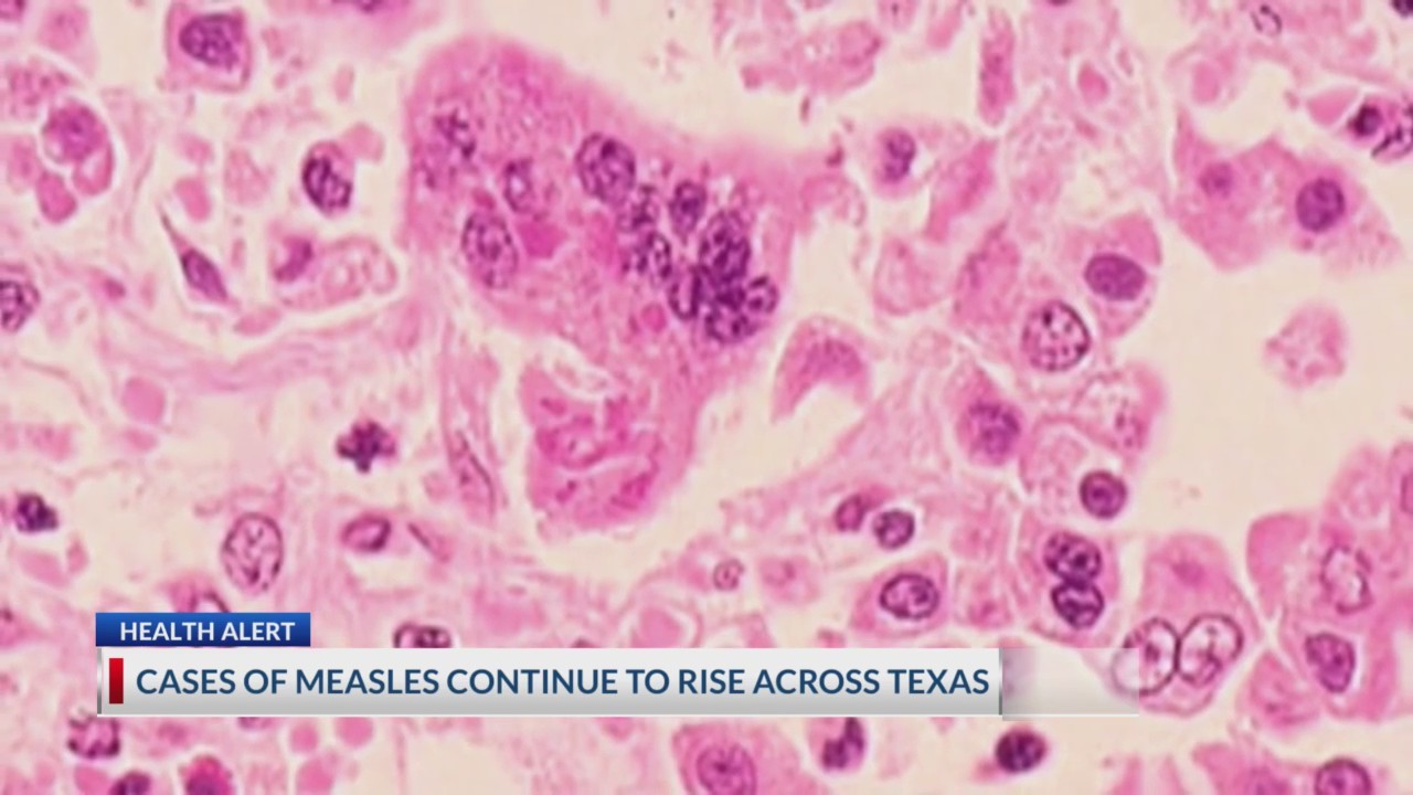 Cases of measles continue to rise across Texas – KTSM 9 News