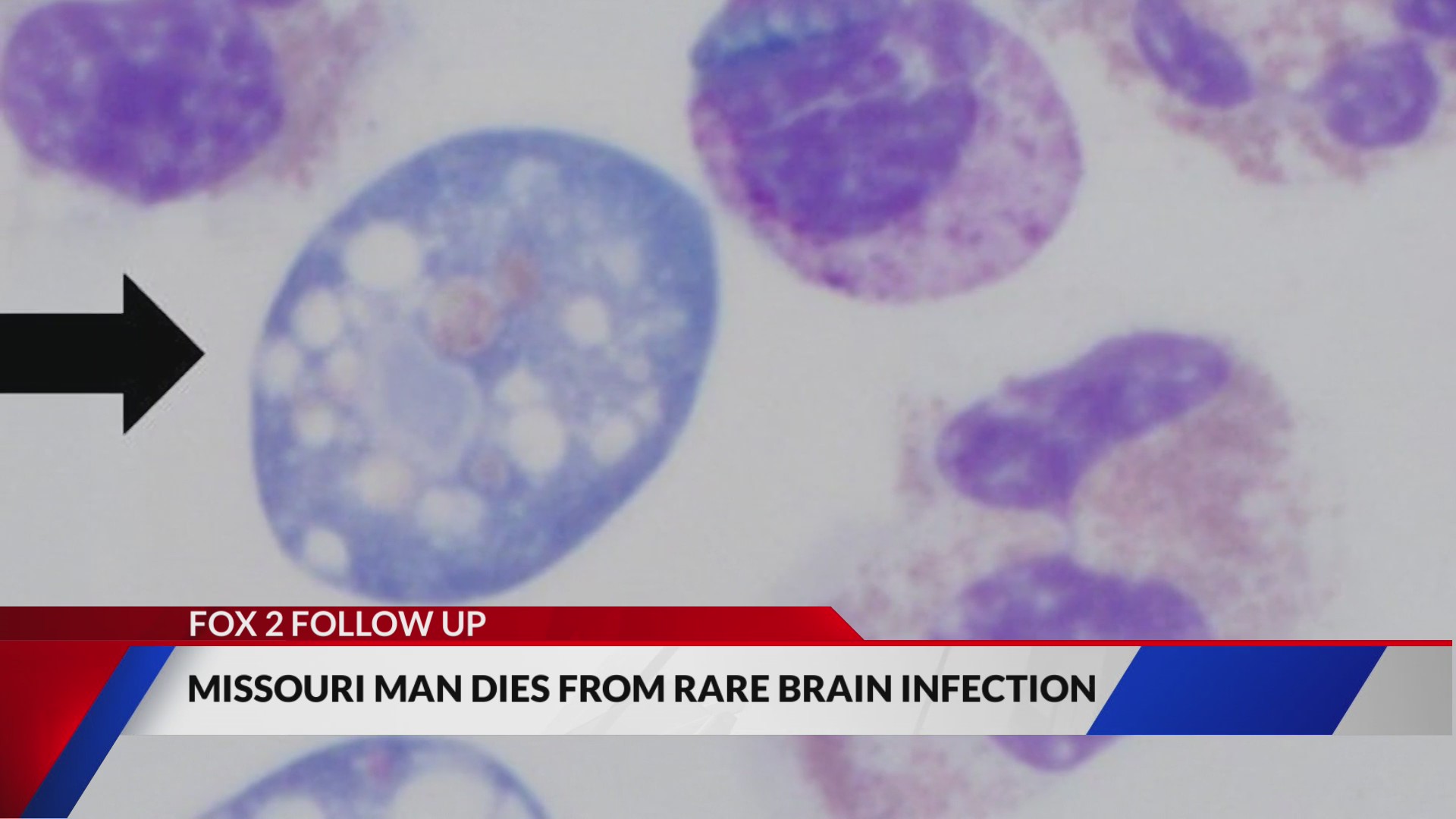 Missouri man dies from rare brain infection – FOX 2
