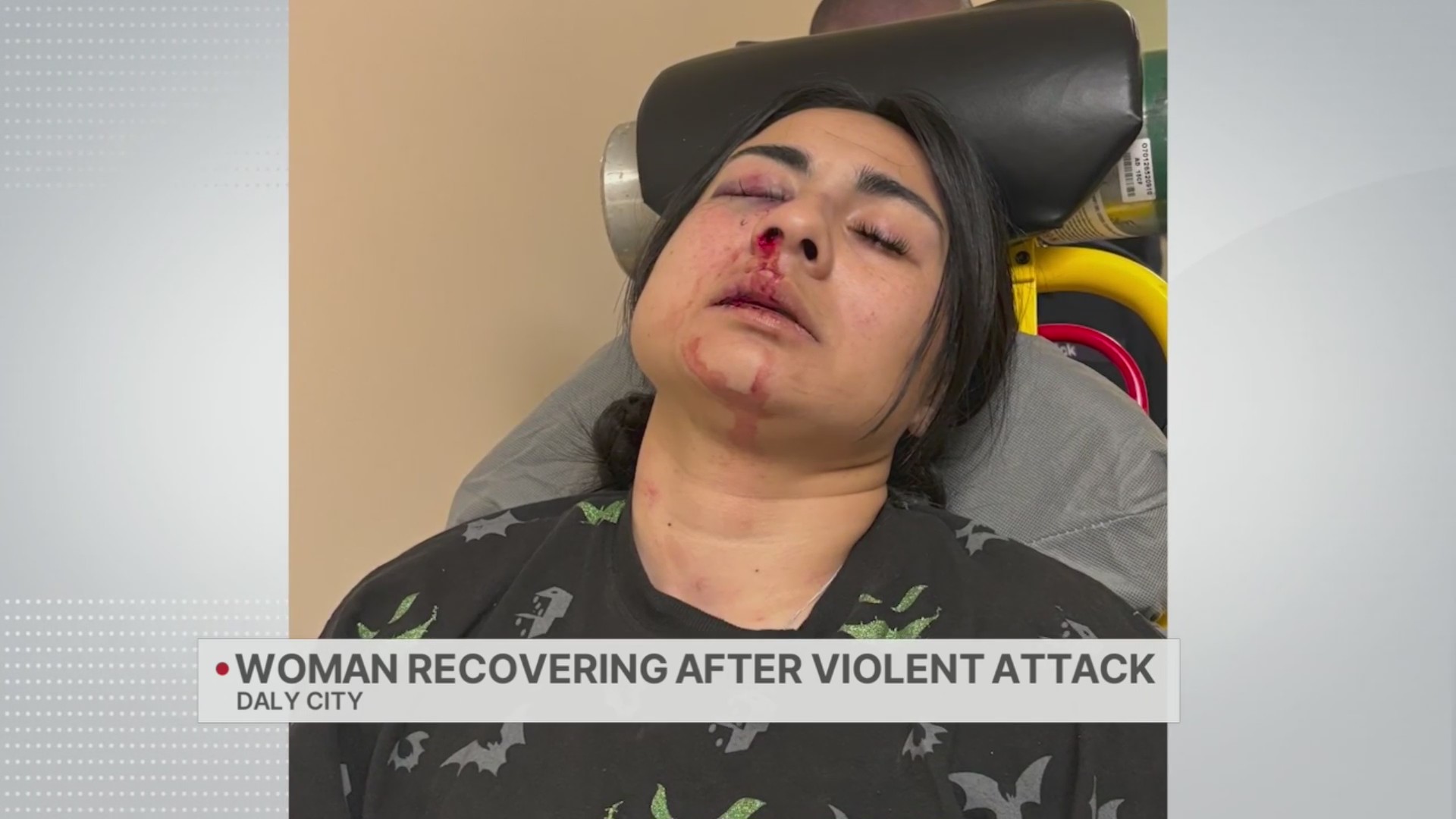 Woman recovering after violent attack in Daly City – KRON4