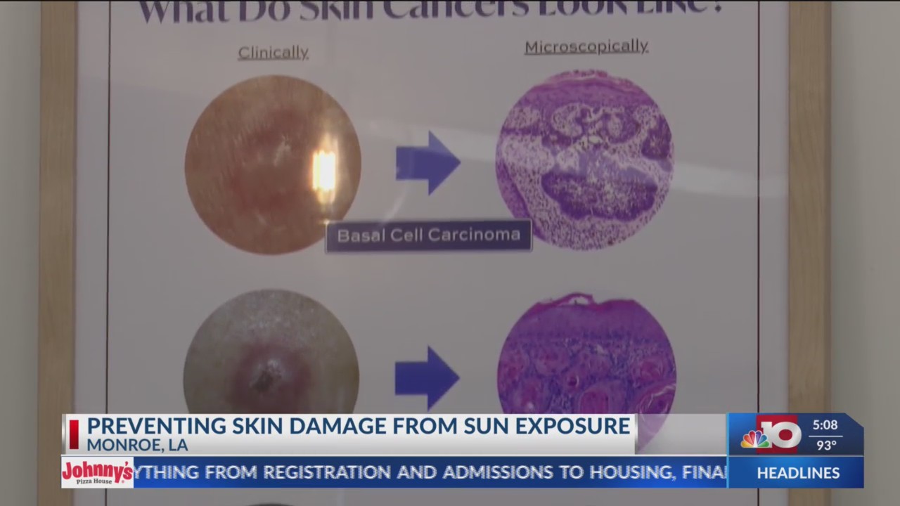 Fun in the sun! Tips on preventing skin damage from sun exposure – KTVE ...