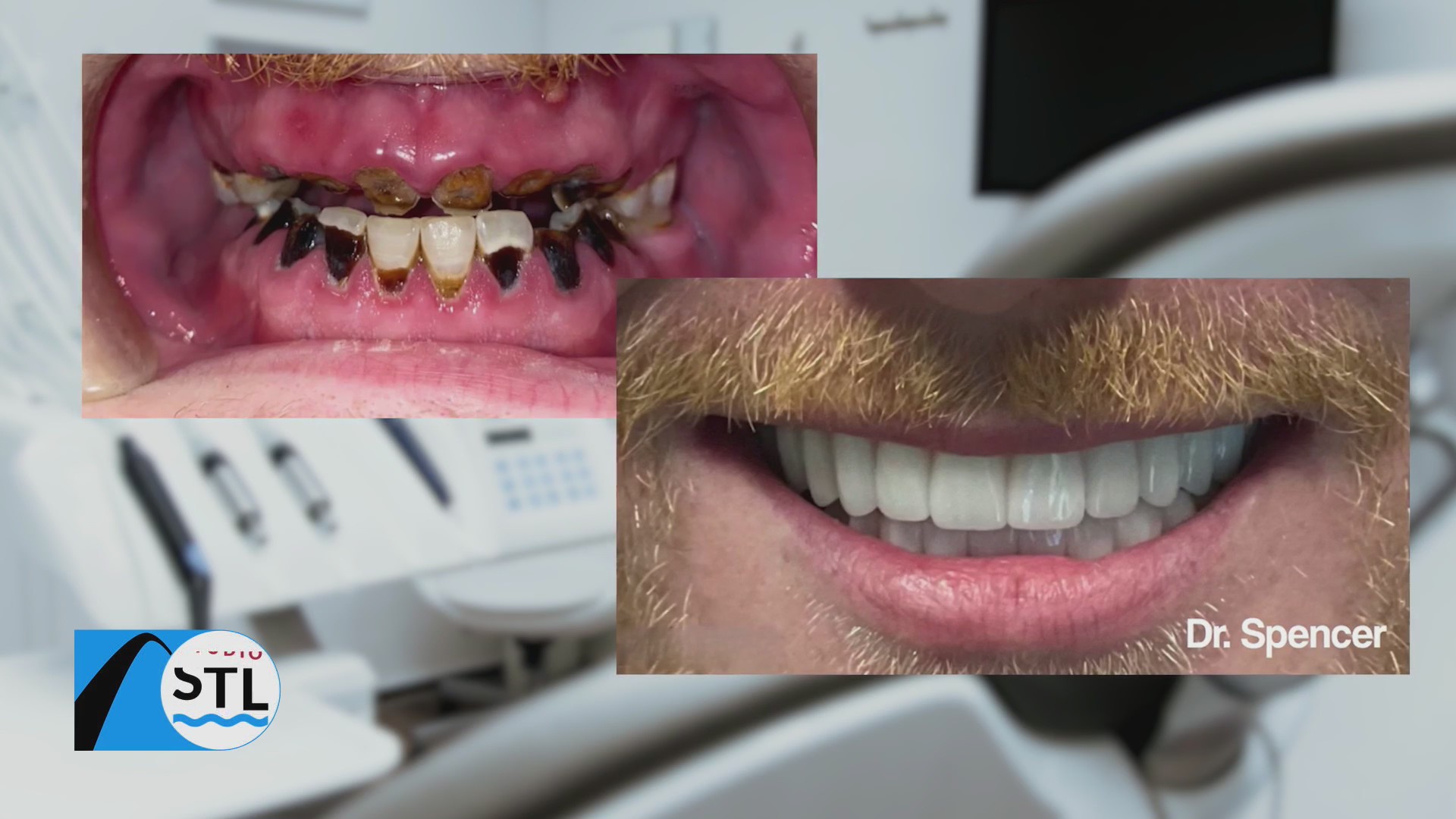 Get dental implants that look real and act like original teeth at Troy