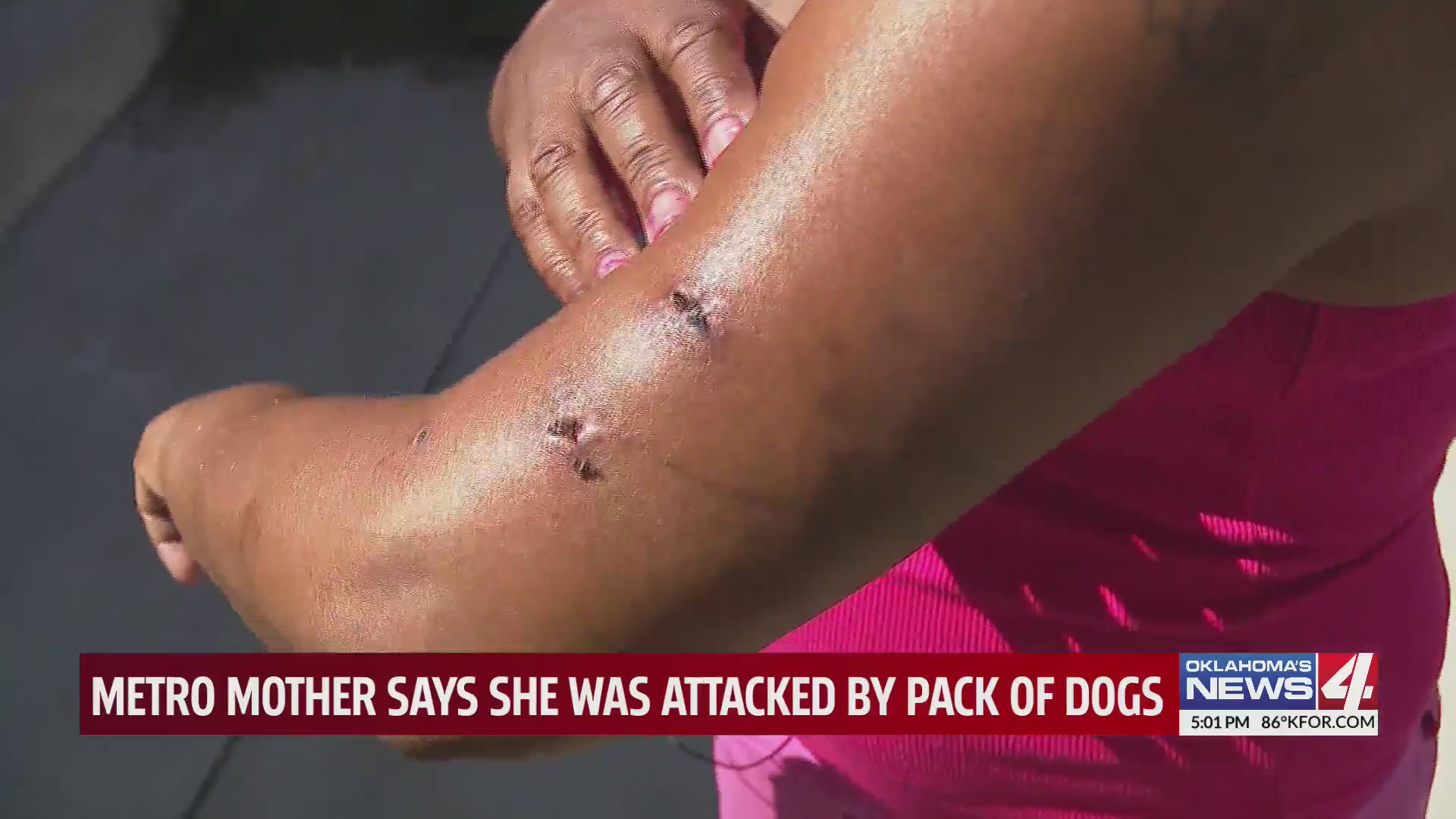 Metro mother says she was attacked by pack of dogs – KFOR.com Oklahoma City
