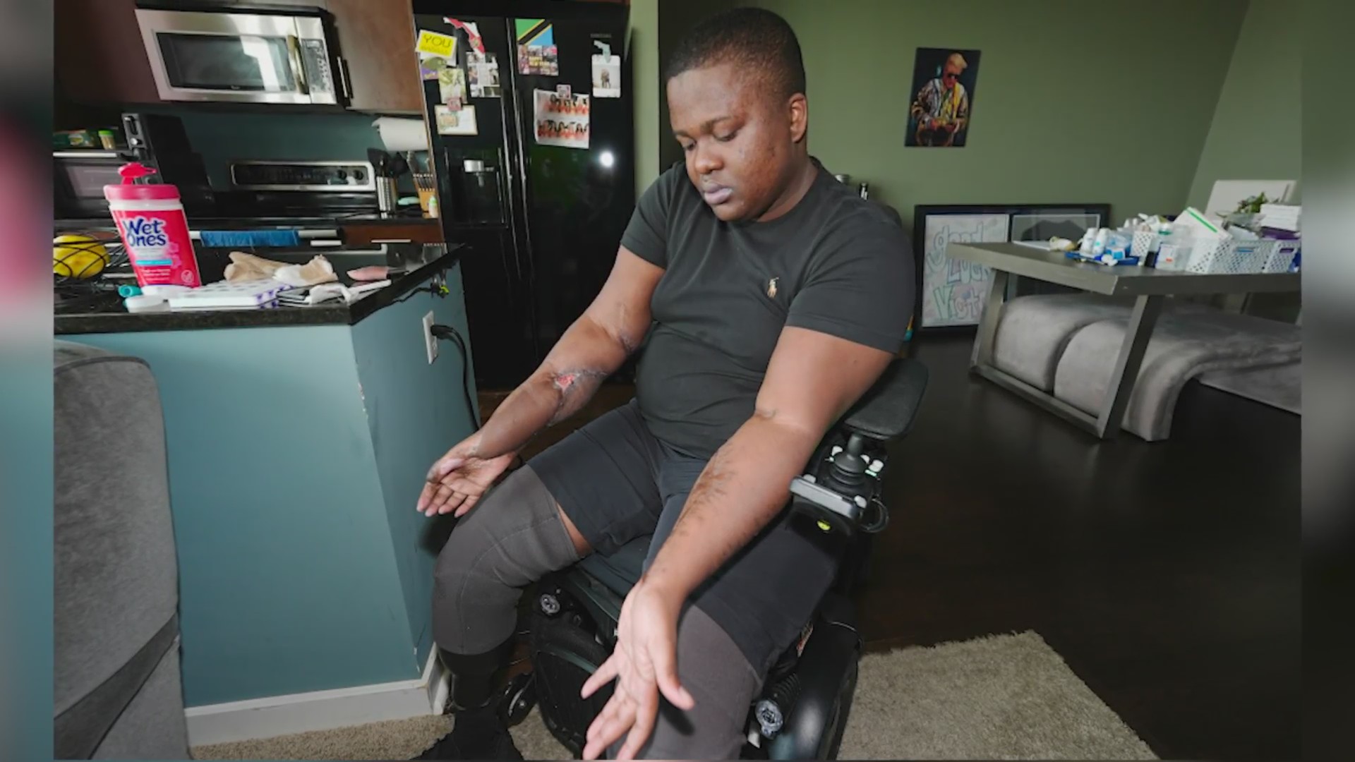 Denver police recruit who lost both legs files lawsuit – FOX31 Denver